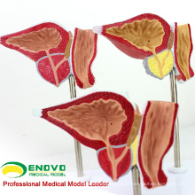 VENDER 12427 Modelo Patológico de Próstata Humana para Educação, Modelo de Exame da Próstata BPH